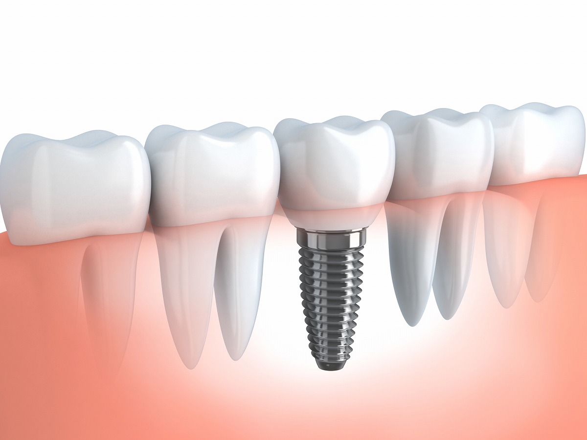 失った歯・周りの歯を残していく「インプラント治療」