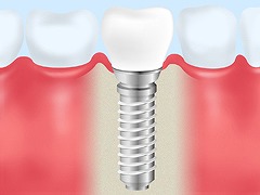 【インプラント】