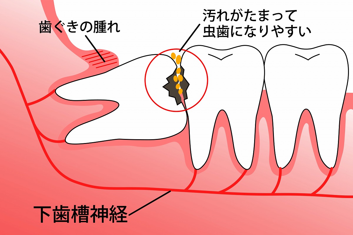 むし歯や歯周病になっている