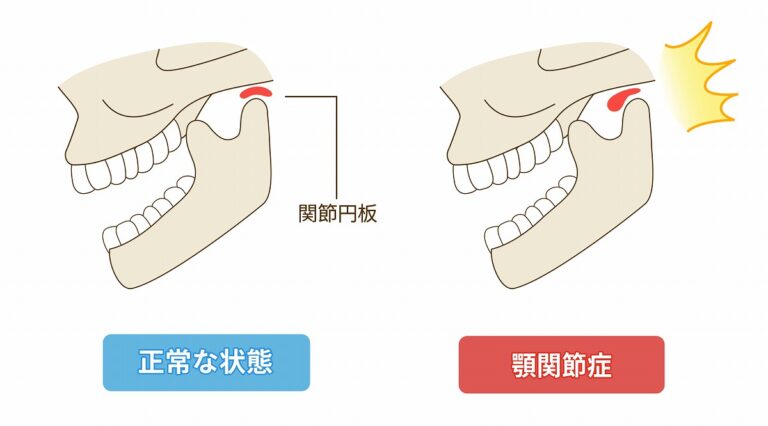 顎関節症