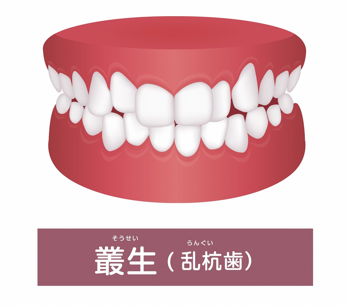 叢生（八重歯、ガチャ歯）