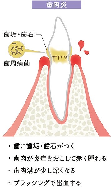 歯肉炎