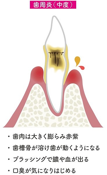 中等度歯周炎