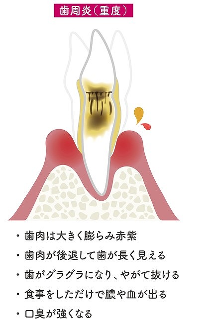 重度歯周炎